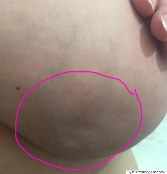 Breast cancer symptoms: What a breast dimple looks like