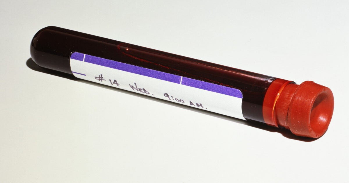 New Pregnancy Blood Test To Detect Down's Syndrome Approved For NHS By