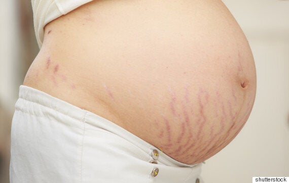 Stretch Marks – Prevention and Treatment