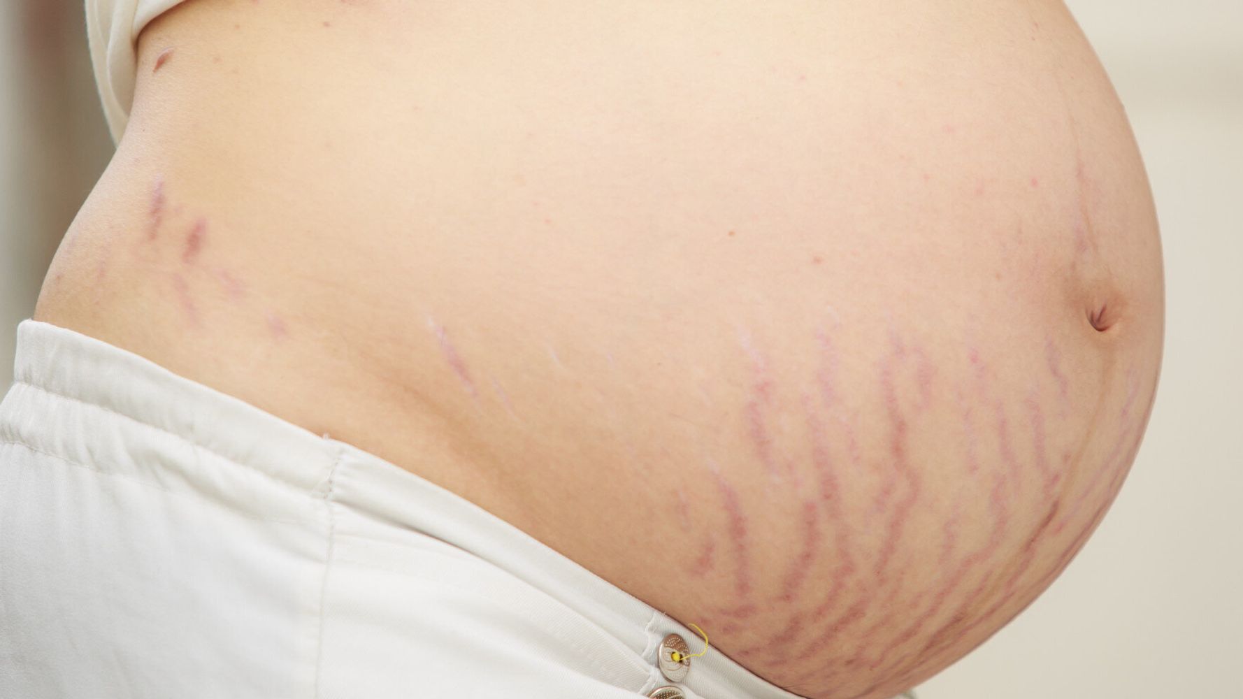 Red bump on stretch mark