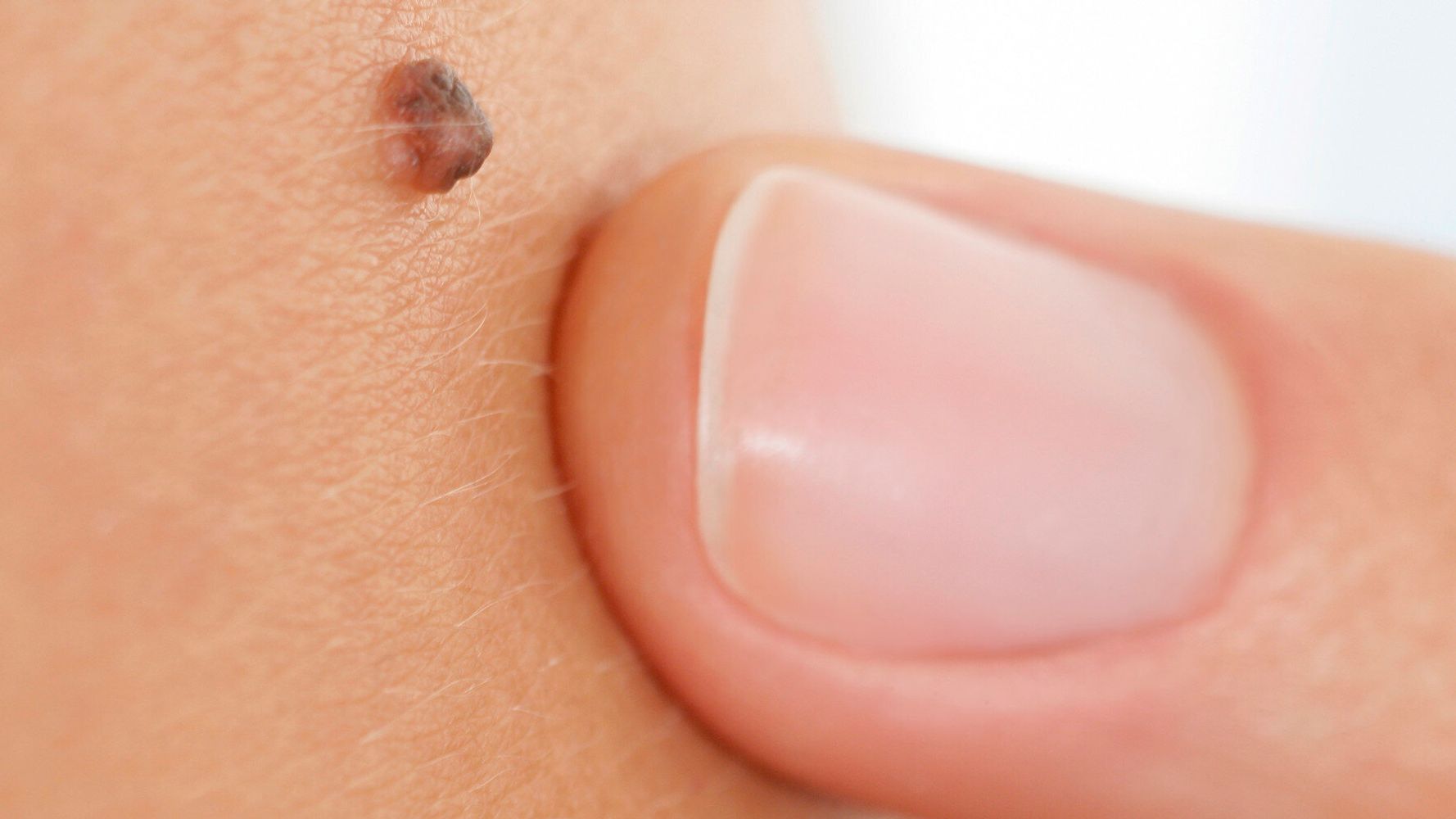 Could Your Mole Be Cancerous Take This Nhs Quiz To Find Out Whether