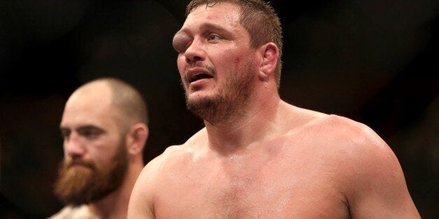 Matt Mitrione's damaged eye is seen after his bout with Travis Browne in their mixed martial arts bout at UFC Fight Night 81, Sunday, Jan. 2, 2016, in Boston. Browne won via third round TKO. (AP Photo/Gregory Payan)