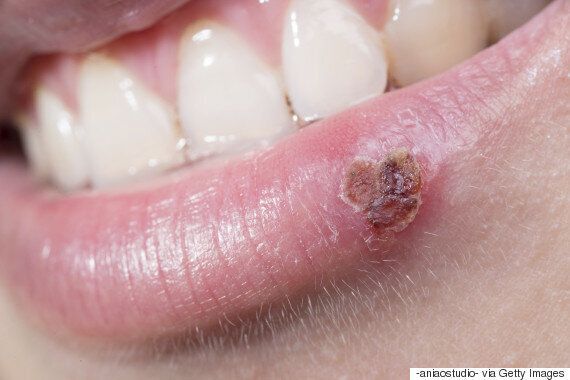 Cold Sores - Is There a Way to Cure the Curse? I've Tried Everything ...