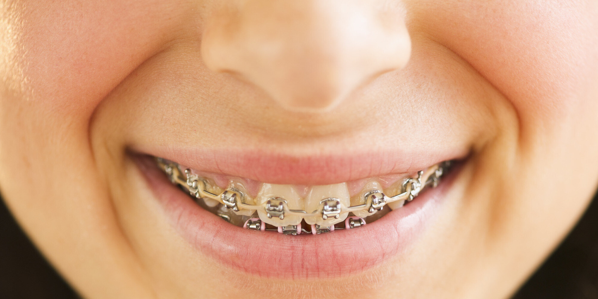 types of braces for adult