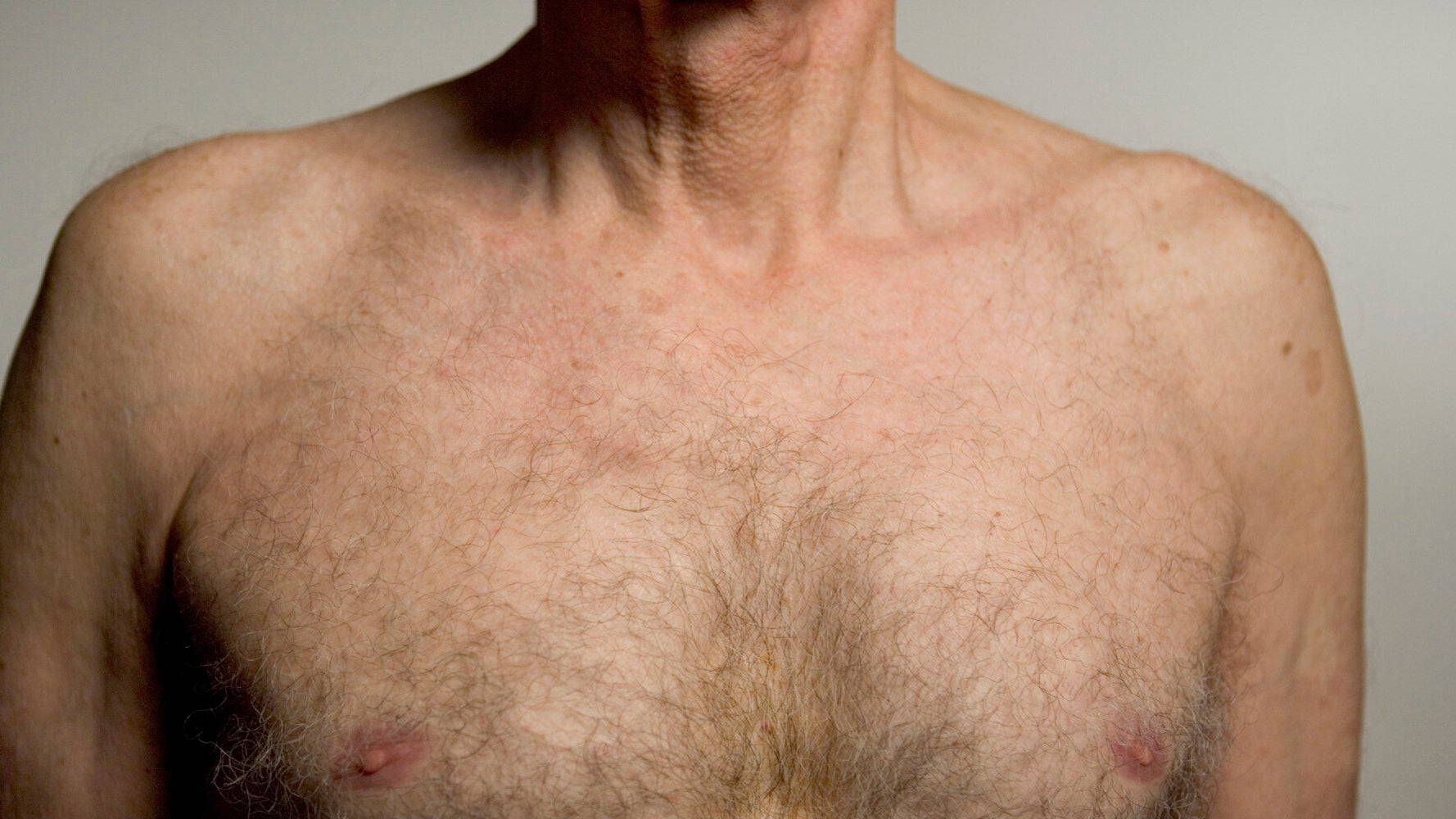 What Causes Pain In Men S Breast Nipples