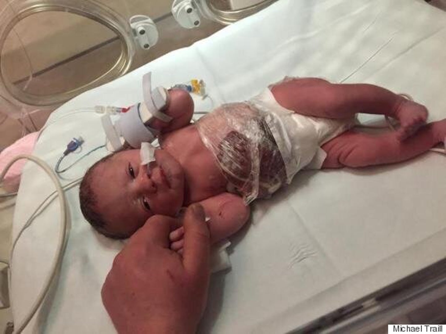 Baby Born With Organs Outside Body Saved By Doctors Who Wrapped Her In ...