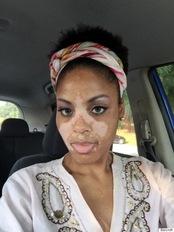 Mum With Vitiligo Embraces Rare Skin Condition Im Still A Normal Woman Huffpost Uk Life 