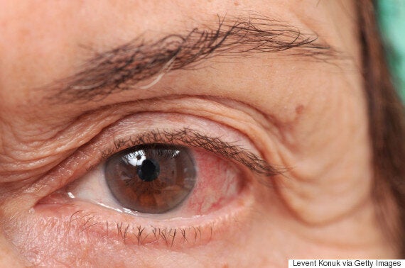 What Is Glaucoma Symptoms Causes And Treatment For The Eye