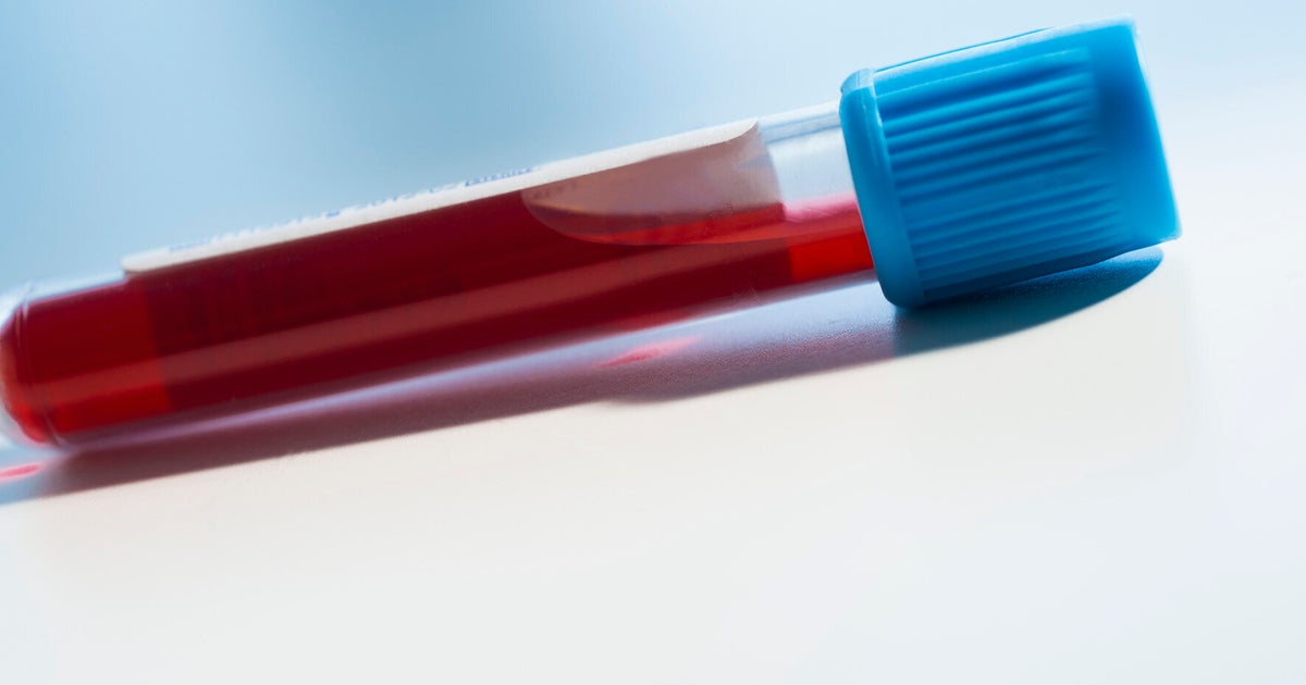 Down's Syndrome Screening In Pregnancy DNA Blood Test For Pregnant