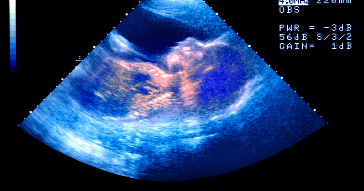 20 Week Scan Why I Was Forced to Miss It! HuffPost UK Parents
