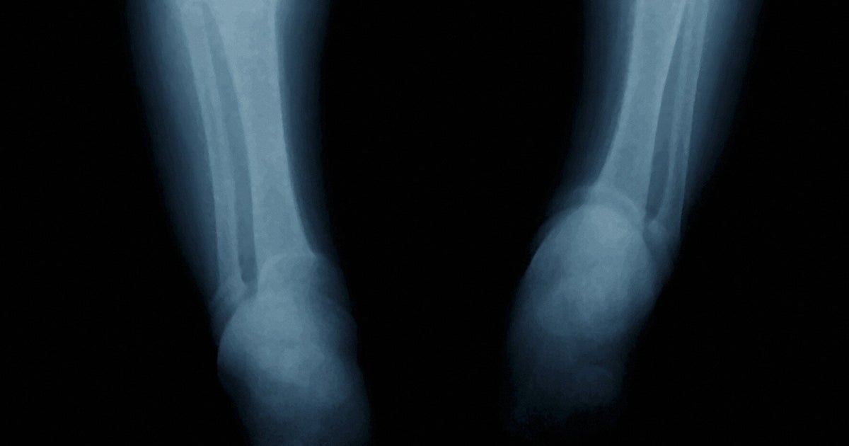 All Children UnderFour May Be Given Free Vitamins To Prevent Rickets