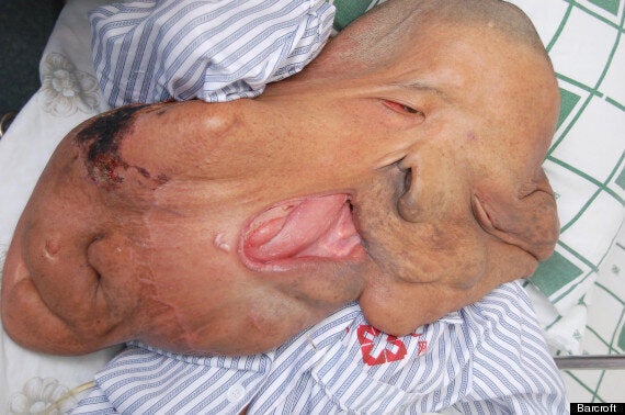 Man with huge face tumor reveals surgery results