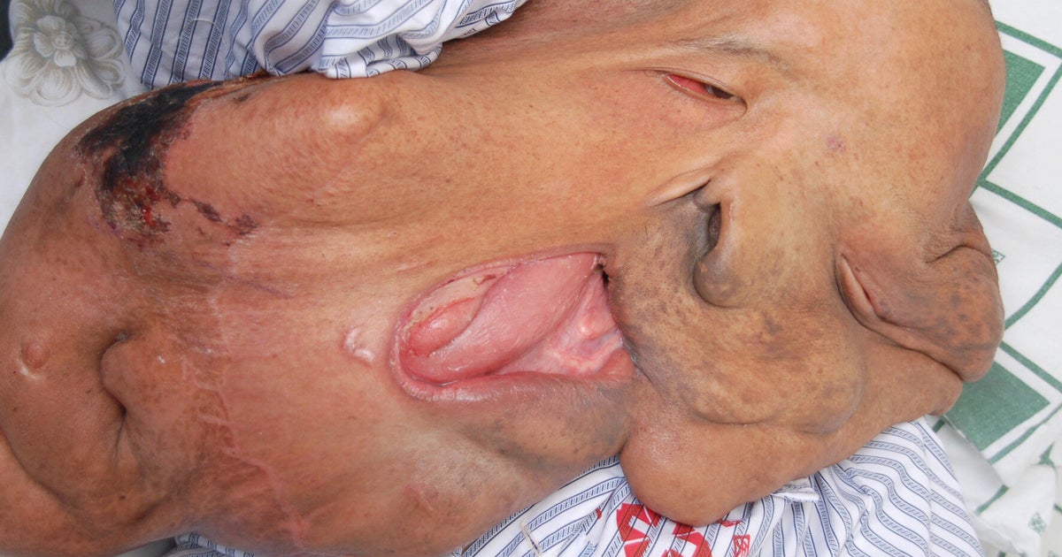 Man with huge face tumor reveals surgery results