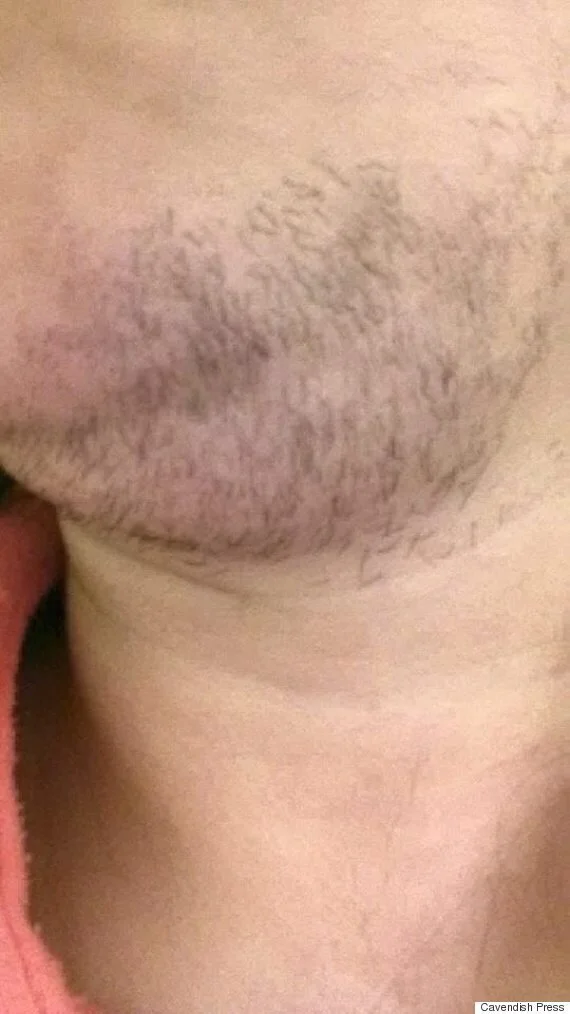 Woman With PCOS, Who Shaves Three Times Per Day, Refused Laser Hair Removal Treatment On NHS - Because It's 'Too Cosmetic' | HuffPost UK Life Woman With PCOS, Who Shaves Three Times Per Day, Refused Laser Hair Removal Treatment On NHS - Because It's 'Too Cosmetic' | HuffPost UK Life