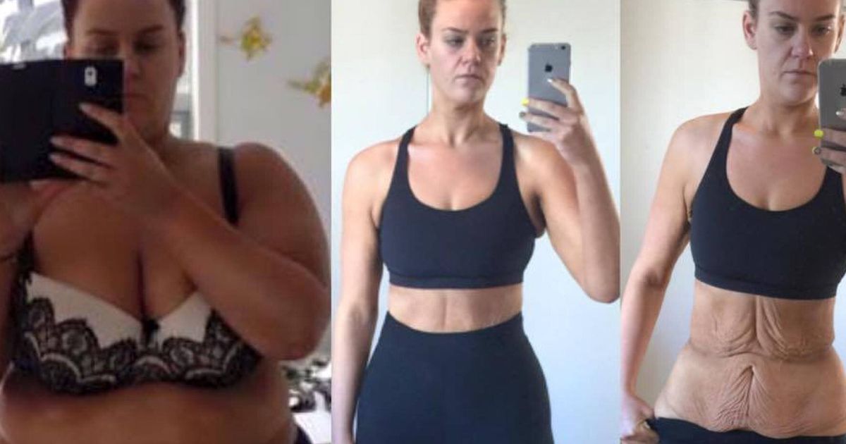 Woman Left With Excess Skin After Extreme Weight Loss Hits Back After