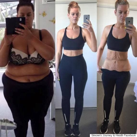 weight loss before and after stomach