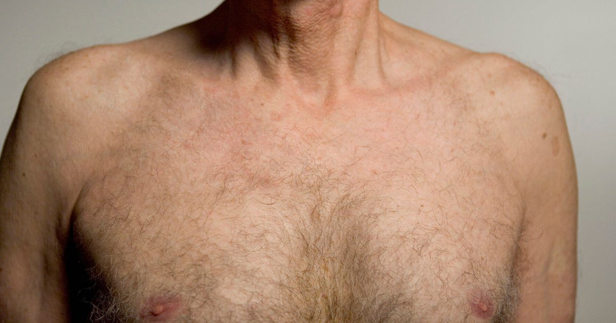 men-with-high-levels-of-oestrogen-more-likely-to-develop-male-breast