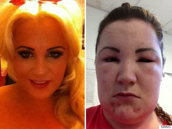 Woman Left Fighting For Her Life After Allergic Reaction To Celebrity-Inspired Hairstyle | HuffPost UK Life Woman Left Fighting For Her Life After Allergic Reaction To Celebrity-Inspired Hairstyle | HuffPost UK Life