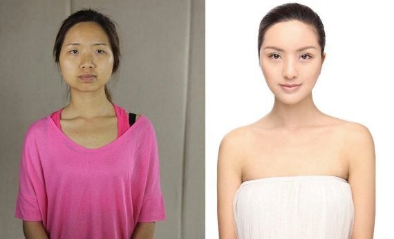 Asian plastic clearance surgery