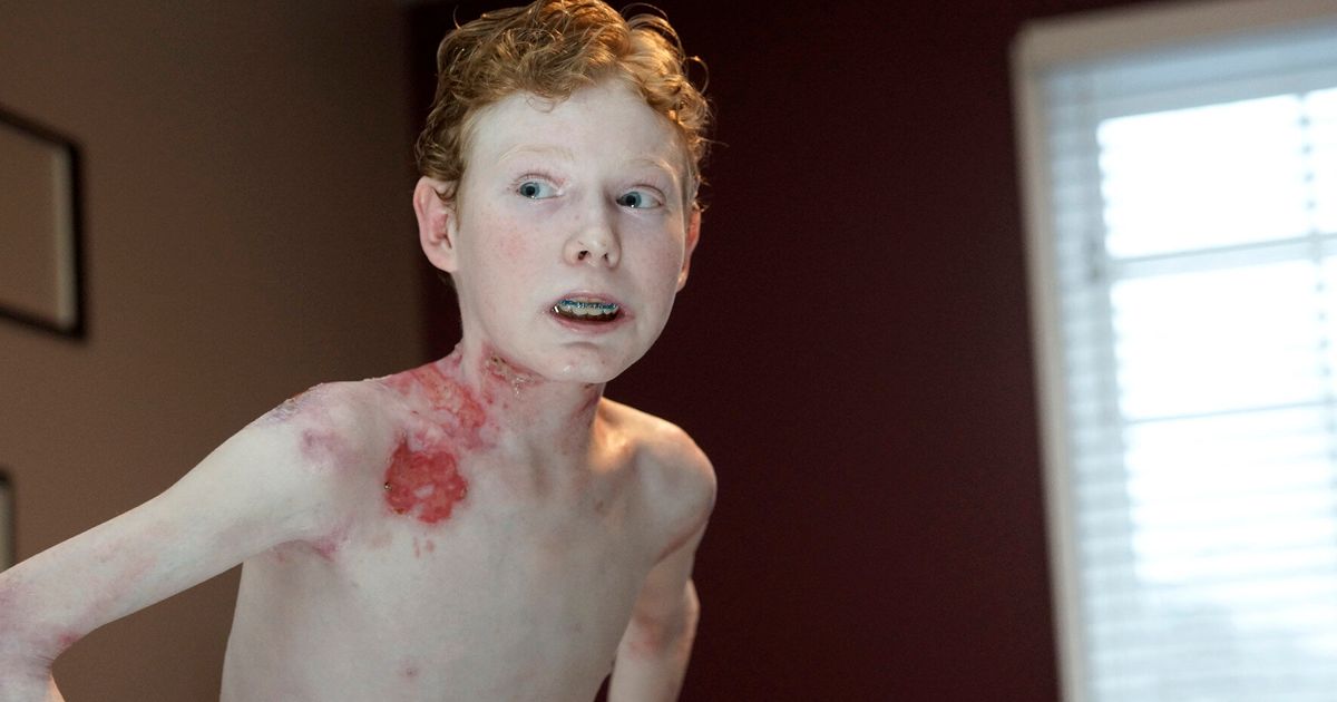Inspirational Butterfly Boy Raises £65k For Rare Condition Which