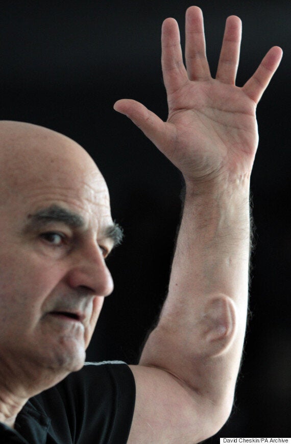 Australian 'Artist' Stelarc Grows Artificial Ear On His Arm To Help