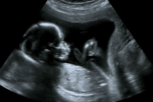 Ultrasound - Skull theory parenting trend 2014