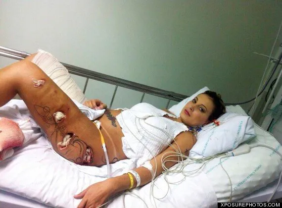 Andressa Porn - Miss BumBum Model Andressa Urach Reveals Horrific Infection Caused By  Cosmetic Fillers (GRAPHIC IMAGES) | HuffPost UK News