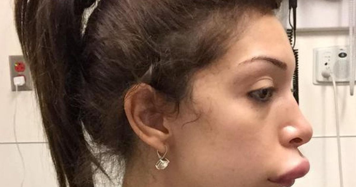 Farrah Abraham Reveals Botched Lip Injection Photos Following Emergency
