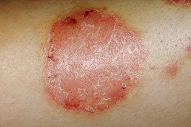 Psoriasis, chronic skin disease w/itchy scaly patches