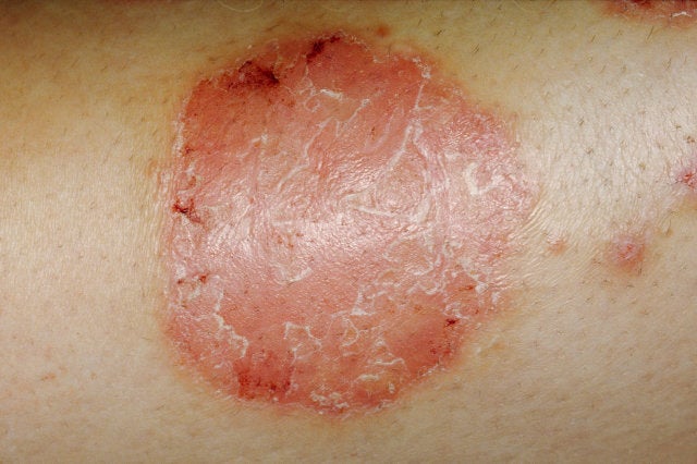 psoriasis child symptoms