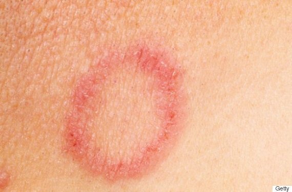 Ringworm In Babies And Children Treatment And Prevention HuffPost UK   5d01b978210000a718eba228 