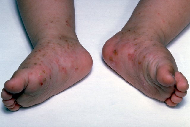 Scabies Symptoms