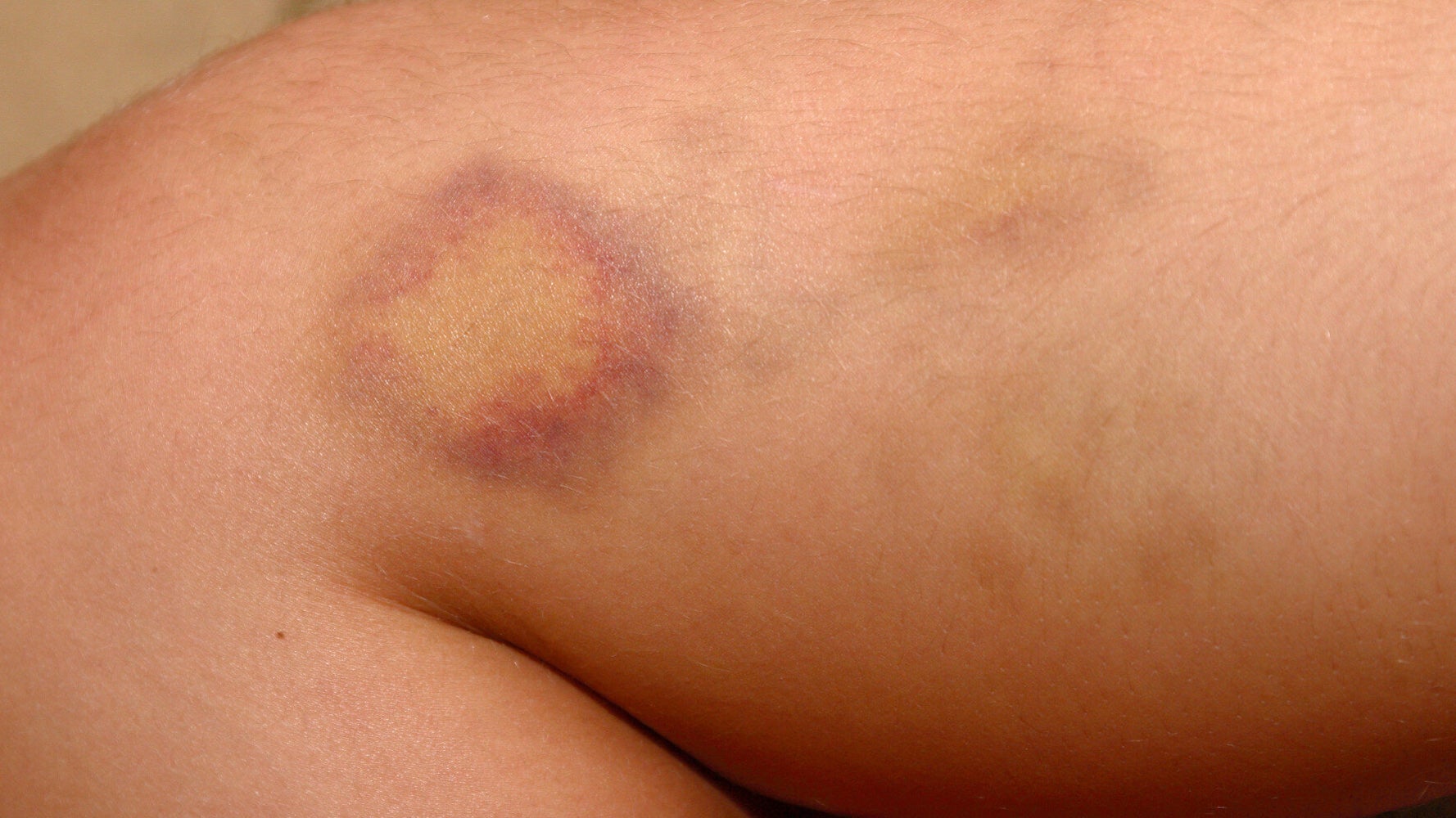 why-do-i-bruise-easily-age-and-gender-may-have-something-to-do-with-it