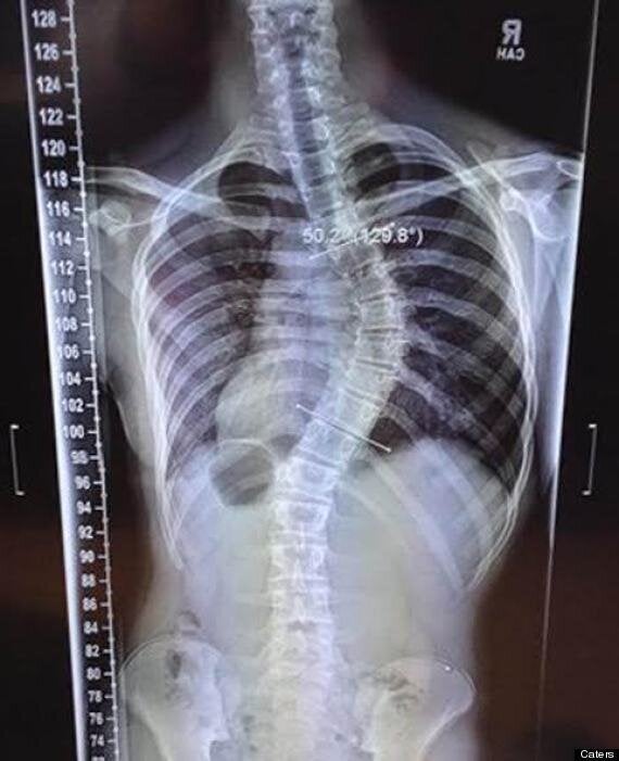 Scoliosis // Middlesex Health