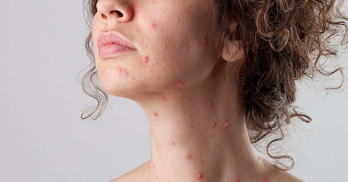 My Experience of Chicken Pox to Author | HuffPost UK Life
