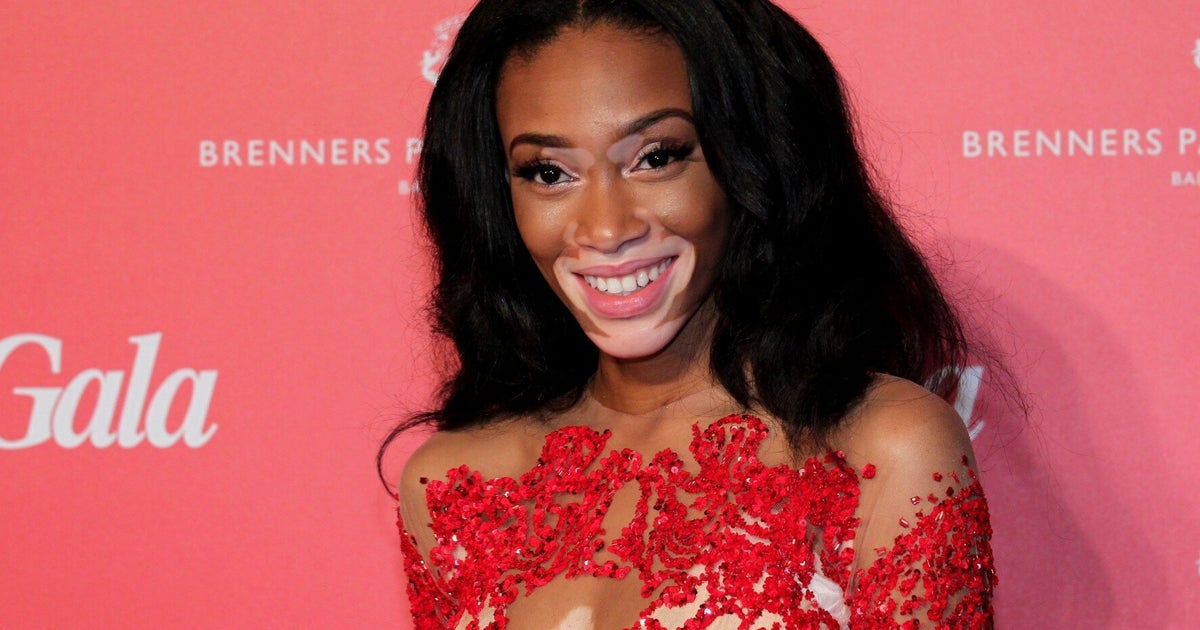 Model With Vitiligo, Winnie Harlow, Wins Beauty Idol Award And Proves