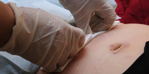 Independent Nurse, In Venissieux, France. Home Of A Patient Having Undergone A Lipectomy And Contracted A Golden Staphylococcus. Dressing. (Photo By BSIP/UIG Via Getty Images)