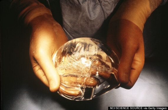 34G Breast Implants Are Deemed Too Big As Harley Street Surgeon Faces  Charges For 'Doomed' Surgery
