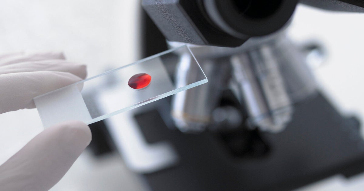 A Blood Test Could Detect Bowel Cancer And Help Prevent 15,000 Deaths A