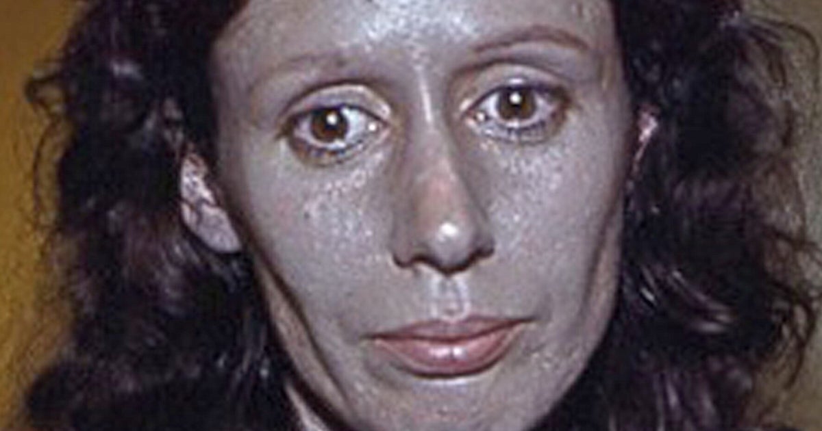 Woman's Use Of Nose Drops Turned Her Skin Silver Now She's Trying To