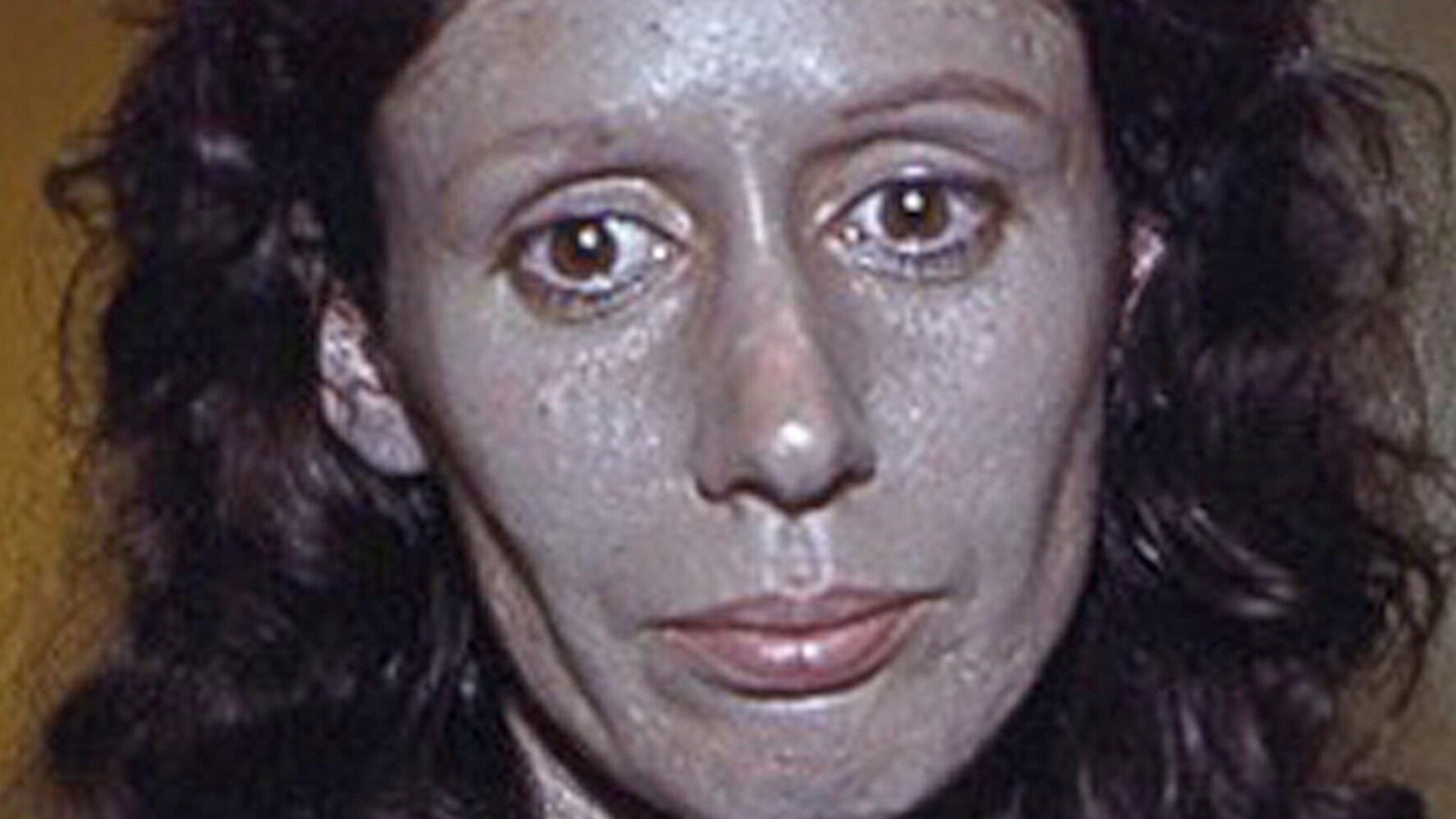 What is argyria, a condition that turns skin colour to blue?