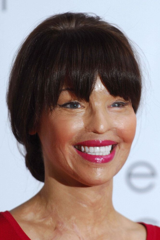 Katie Piper, Acid Attack Model, Gets Eyesight Back With Stem Cell Treatment