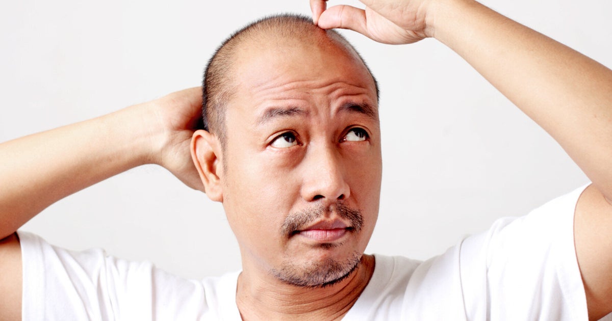 Is This Laser Helmet The Cure For Baldness? (VIDEO) HuffPost UK Life