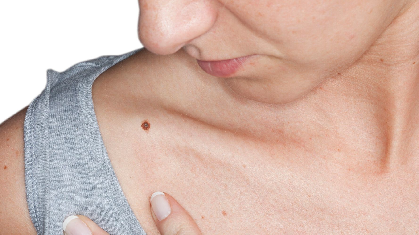 Can Breast Cancer Cause Moles