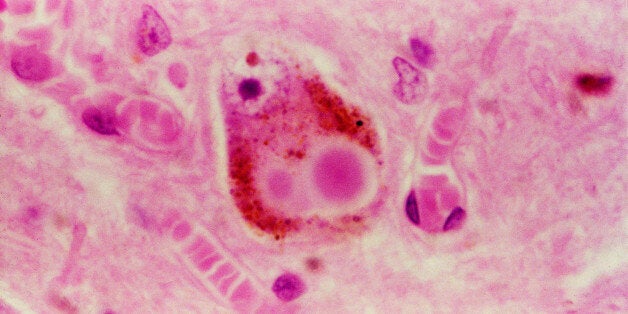 Micrograph of human brain shows signs of Parkinson's disease. Spherical inclusions seen in the melanin-containing neurons in Parkinson's disease, knwon as Lewy bodies, (center circular area). Typically they have a hyaline core and pink halo.