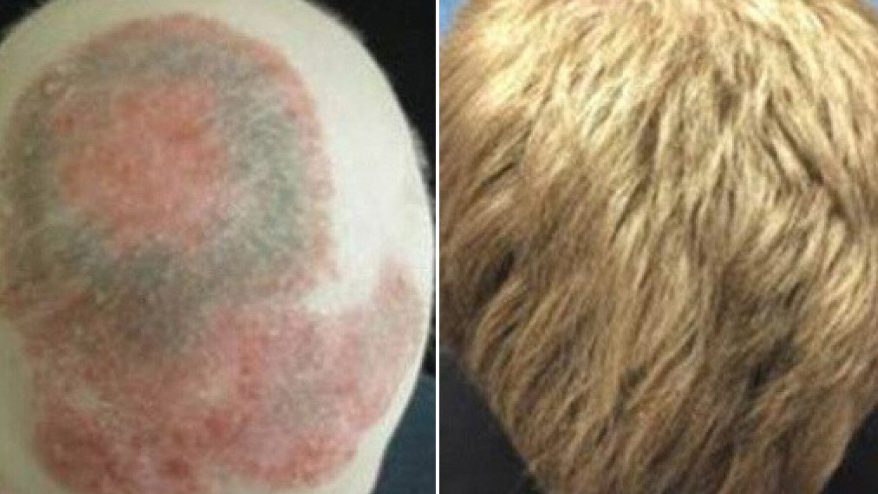 Successful Hair Loss Treatment: Yale Scientists Use Drug To Completely Regrow A Man's Hair Back | HuffPost UK Life Successful Hair Loss Treatment: Yale Scientists Use Drug To Completely Regrow A Man's Hair Back | HuffPost UK Life