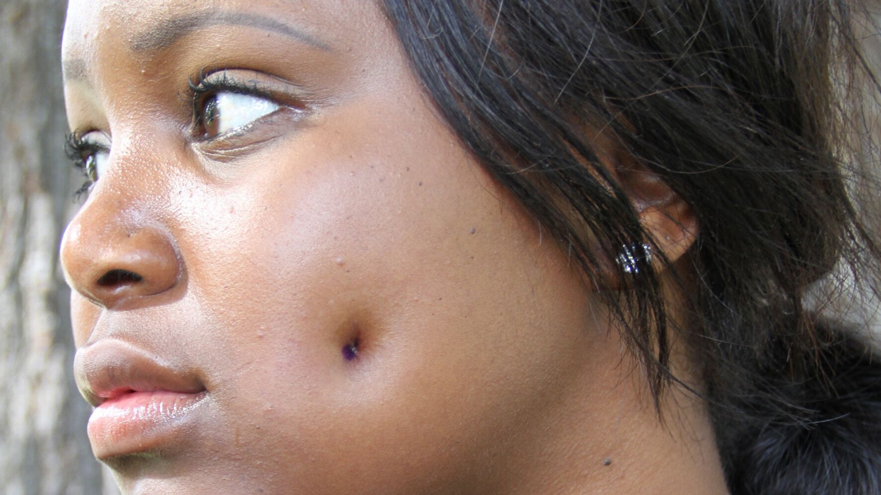 Dimpleplasty Woman Gets £1500 Cheek Piercing Surgery To Get Dimples