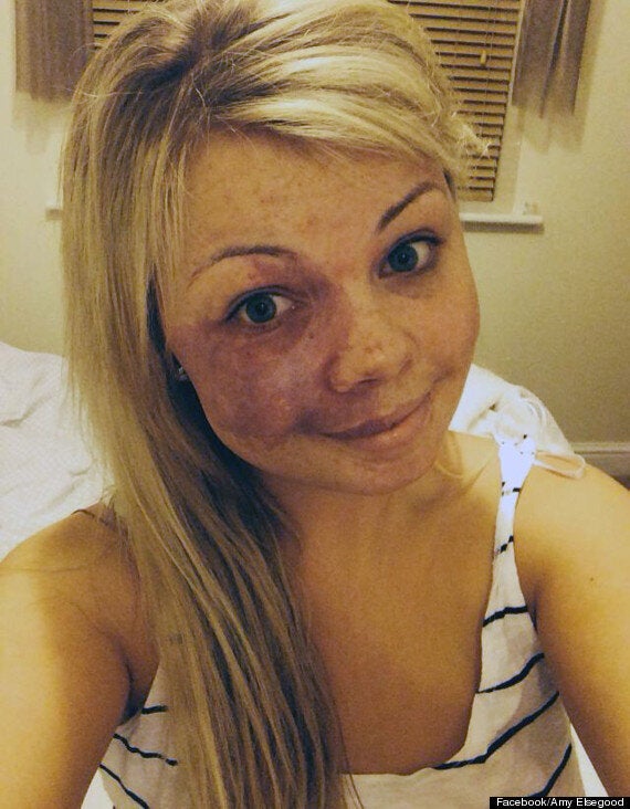 Young Woman Shows Facial Birthmark In No Make Up Selfie The Internet Hugs Back Huffpost Uk Life 