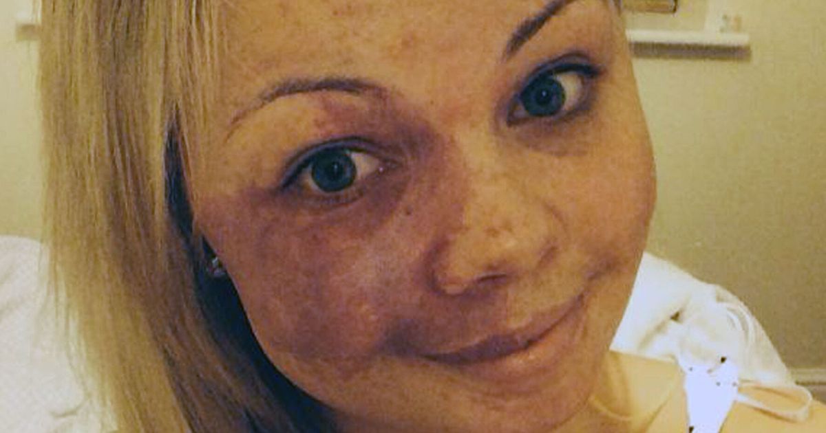Young Woman Shows Facial Birthmark In No Make Up Selfie The Internet 