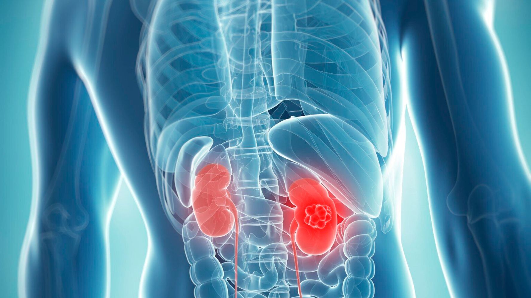 Kidney Cancer New Method Using 'Glowing Dye' Has Been